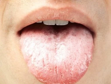 Γλώσσα: Τι αποκαλύπτει το εκάστοτε χρώμα της για την υγεία σας